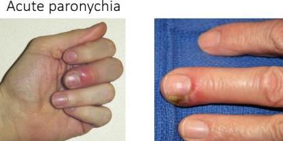 The patient keeps biting their fingers infecting the area, crusting the vesicles or even causing the formation of ulcers. The patient usually presents with vesicles and regional lymphadenopathy.