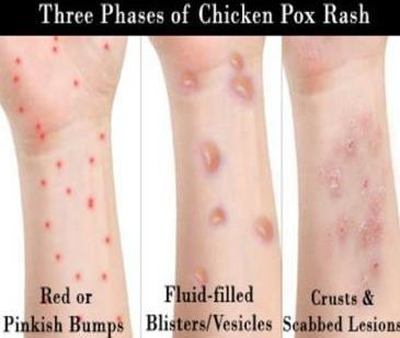 (redness/hotness/pain/fever) Can progress to abscess formation and nail bed infection which are serious. Pus may be seen (no pus in whitlow). Soak for 15 minutes in warm water or acetic acid soak.