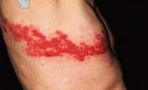 The papules appear in crops over 2-4 days.