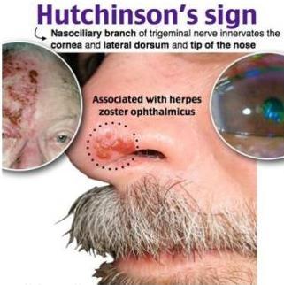 Herpes Ophthalmicus Occurs when the virus is dormant in the trigeminal nerve ganglion. It reactivates in immunocompromised and old aged people.