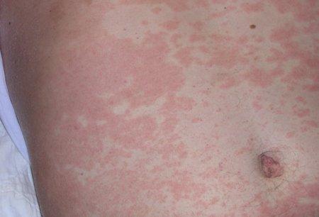 org/wiki/exanthem Viral Exanthem Blanching erythematous maculopapular rash Other viral symptoms (URI, diarrhea, etc) Immunization status (measles and rubella)