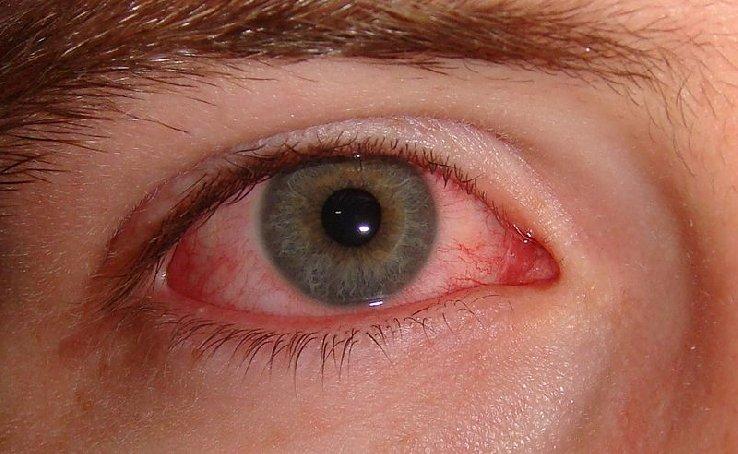 Conjunctivitis - What else could it be Viral vs Bacterial conjunctivitis May be allergic also pruritic (antihistamine) Not painful