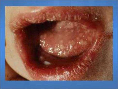 HSV-1 Pharyngitis Stomatitis http://image.slidesharecdn.