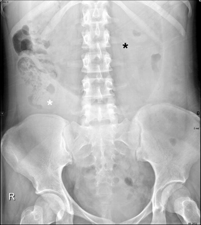 14. Jeong SH, Ha CY, Lee YJ, Choi SK, Hong SC, Jung EJ, et al. Acute gastric volvulus treated with laparoscopic reduction and percutaneous endoscopic gastrostomy.