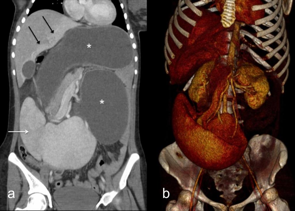 Figure 3: A 22-year-old female with wandering spleen, gastric and pancreatic volvulus and right-sided descending colon.