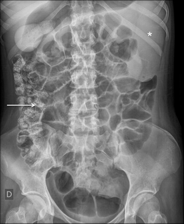 FINDINGS: Abdominal plain film after endoscopic devolvulation shows the return of the spleen and transverse colon to a normal position (white asterisk) and resolution of the gastric volvulus.