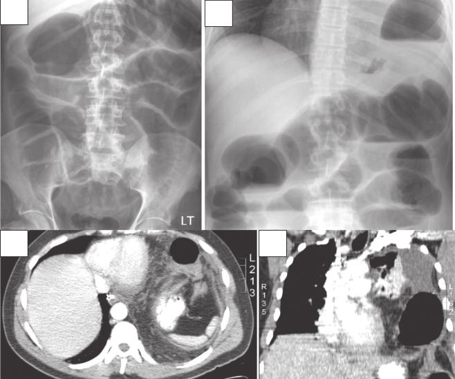 Pantongrag-Brown L THAI J Vol. 16 No. 2 May - Aug. 119 Case 10. A 44-year-old man presented with nausea and vomiting and previous history of car accident. A B C D Figure 10.