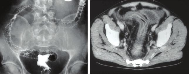 116 Imaging of The Colon Case 7. A 67-year-old man presented with acute abdominal pain and diarrhea. Figure 7.