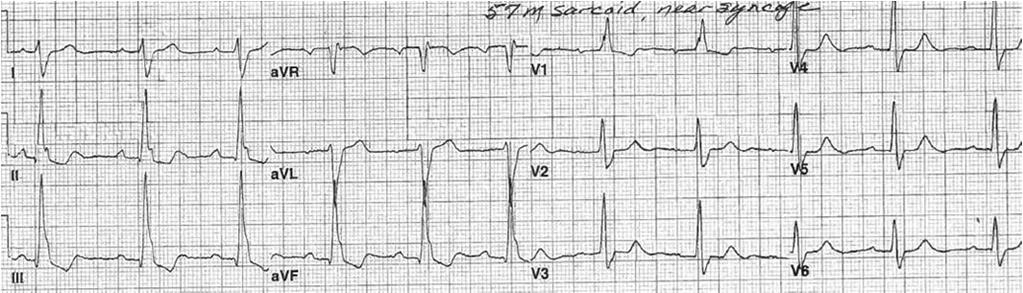 -SR with st degree AV block -RBBB -Left posterior fascicular block 57 y/o with sarcoidosis, presents with near syncope Keys to diagnosing LBBB: -QRS > 20 ms -rsr pattern V and V2 (R taller then r)