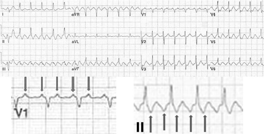 56 y/o with palpitations -A flutter -AV block 2: 74 y/o with palps -Suspect atrial flutter when the