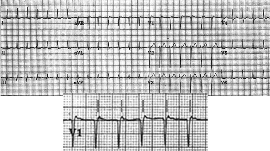 -SVT (likely AVNRT) 2 y/o women -Find the P wave (compare