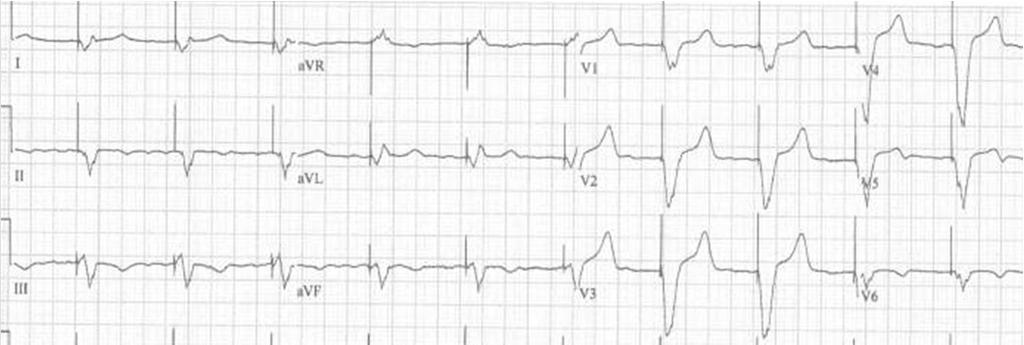 with ventricular paced rhythm, look for atrial activity