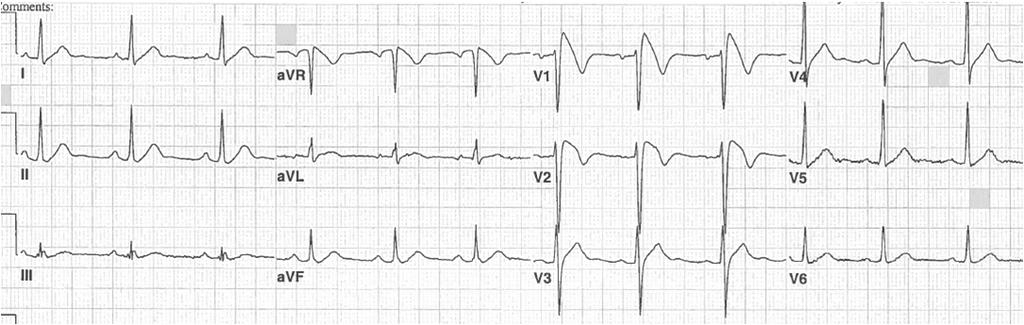 Pattern (type I) 22 y/o with syncope -RBBB with STE in the