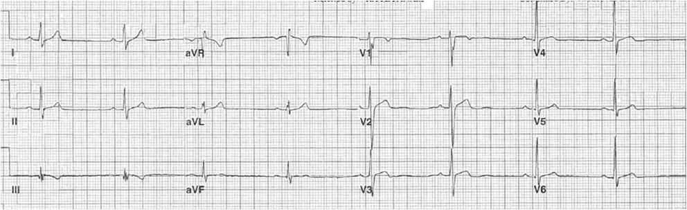 -Sinus rhythm -Short QT -Risk for SCD with structurally normal heart 8 y/o Short QT Syndrome (SQTS). Expert Consensus Recommendation on SCQS. SQTS is diagnosed in the presence of a QTc 330 msec 2.
