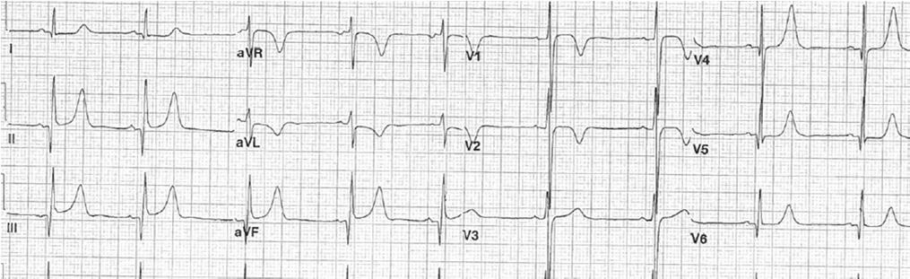 Key for HCM -ECG is rarely normal, but findings are not often specific -Can have prominent voltages with