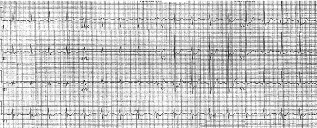 Sinus tach Posterior MI, acute or recent -With ST segment depression in V-V3, consider posterior STEMI -R wave in these