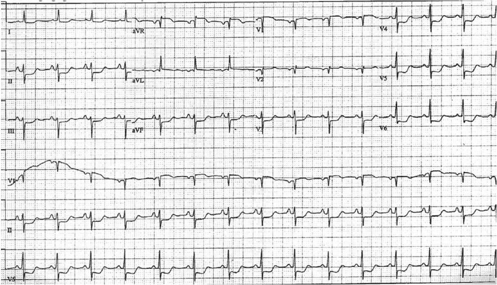 SR LAFB ST changes suggest ischemia 53 y/o DM presents with CP -diffuse ST segment Depression with STE in avr suggests multivessel / LM disease *Courtesy (with permission) of Eric S Williams, MD from