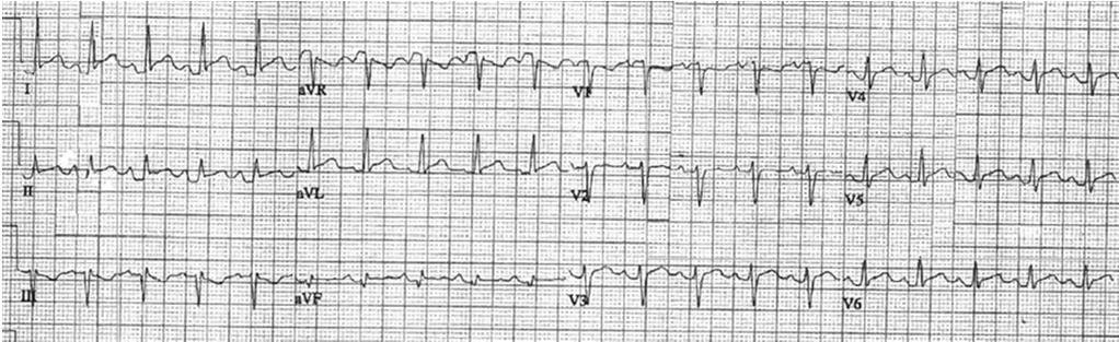 Sinus Tachycaria Acute Pericarditis 42 y/o with chest pain -Diffuse ST