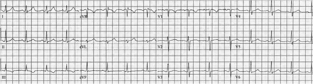 wave inversion Normal ECG -Normally T wave is inverted in V, avr, and