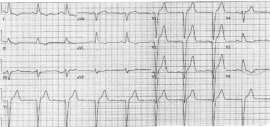 -sinus bradycardia -LBBB 49 y/o CAD history Keys to diagnosing LBB: -QRS > 20 ms -Broad, notched or slurred R wave in I, avl, V6.