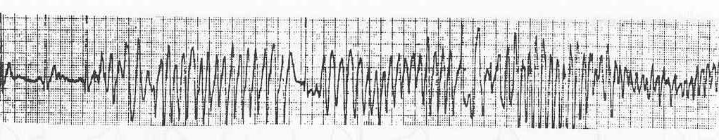 Disappearance of Ventricular Pre-excitation