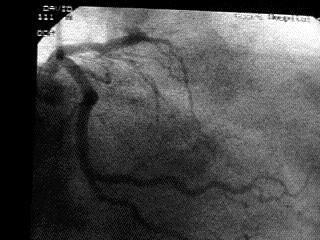 Anomalous coronary arteries D) Adult congenital heart diseases E) Mitral valve prolapse DISEASES & CONDITIONS