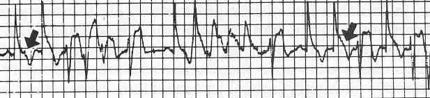 C) Wolff-Parkinson-White syndrome D) Familial catecholaminergic polymorphic VT E) Short QT syndrome F) Other