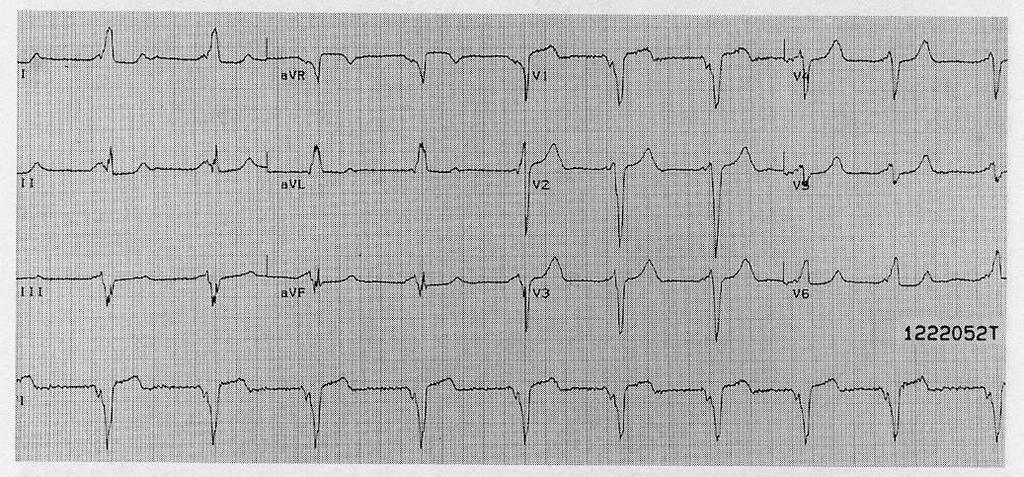 PRE-EXCITED QRS