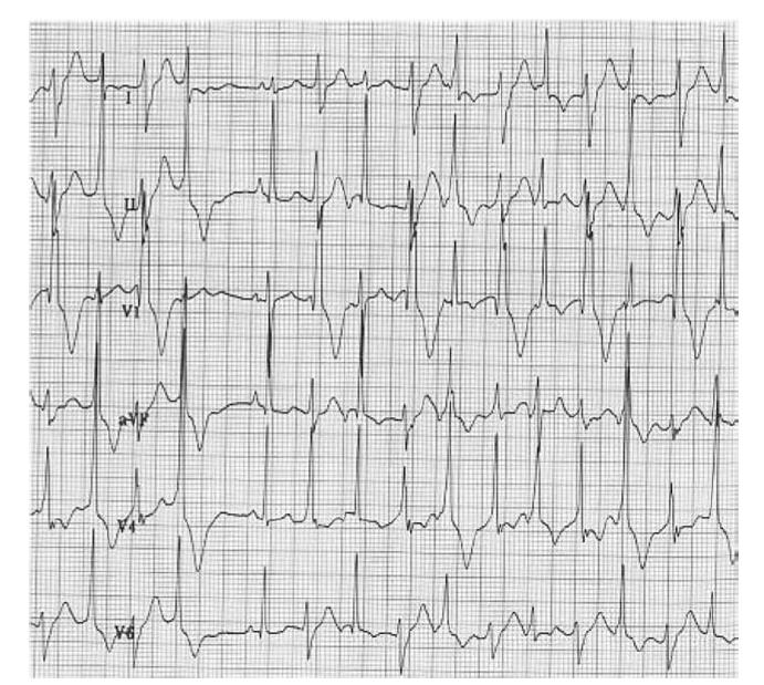 Familial catecholaminergic polymorphic VT: Bidirectional VT in a Child ACQUIRED LONG QT Drug-related Repolarization Abnormality CAUSES OF