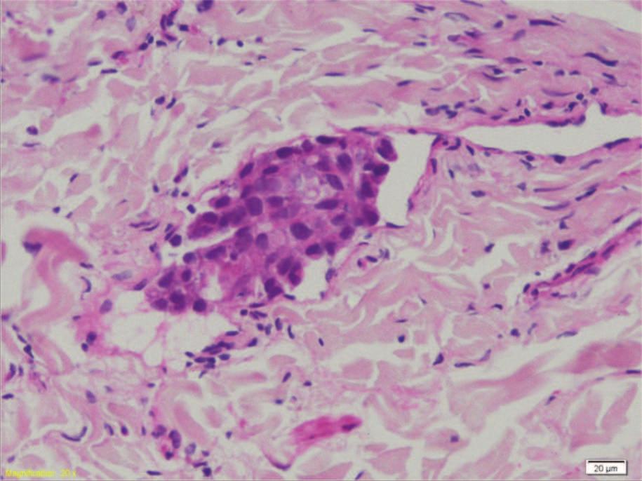 Detailed image of histopathological highlighting tumor emboli intra lymphatic, formed from micropapilar carcinoma Cluj-Napoca, respectiv schimbarea liniei de chimioterapie, cu introducerea Taxol ºi