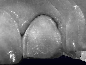 be the loss of gingival crest height.