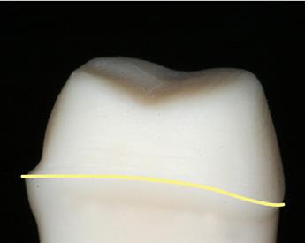 POSTERIOR RESTORATIONS CROWN PREPARATION GUIDELINES ASPECTS TO AVOID FEATHER EDGE