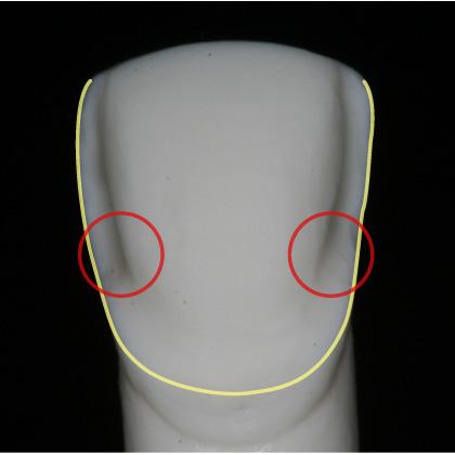 ANTERIOR RESTORATIONS CROWN PREPARATION GUIDELINES ASPECTS TO AVOID This type of preparation with