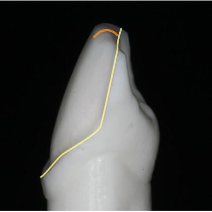 Anterior preparations with undercuts may cause a bad proposal on Autogenesis due to inaccurate