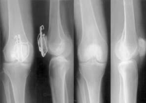 Yu-Chi Huang, et al 266 Fig. 1 Case 1. A 52-year-old man sustained a right patellar fracture, and the fracture was treated with tension band wiring.