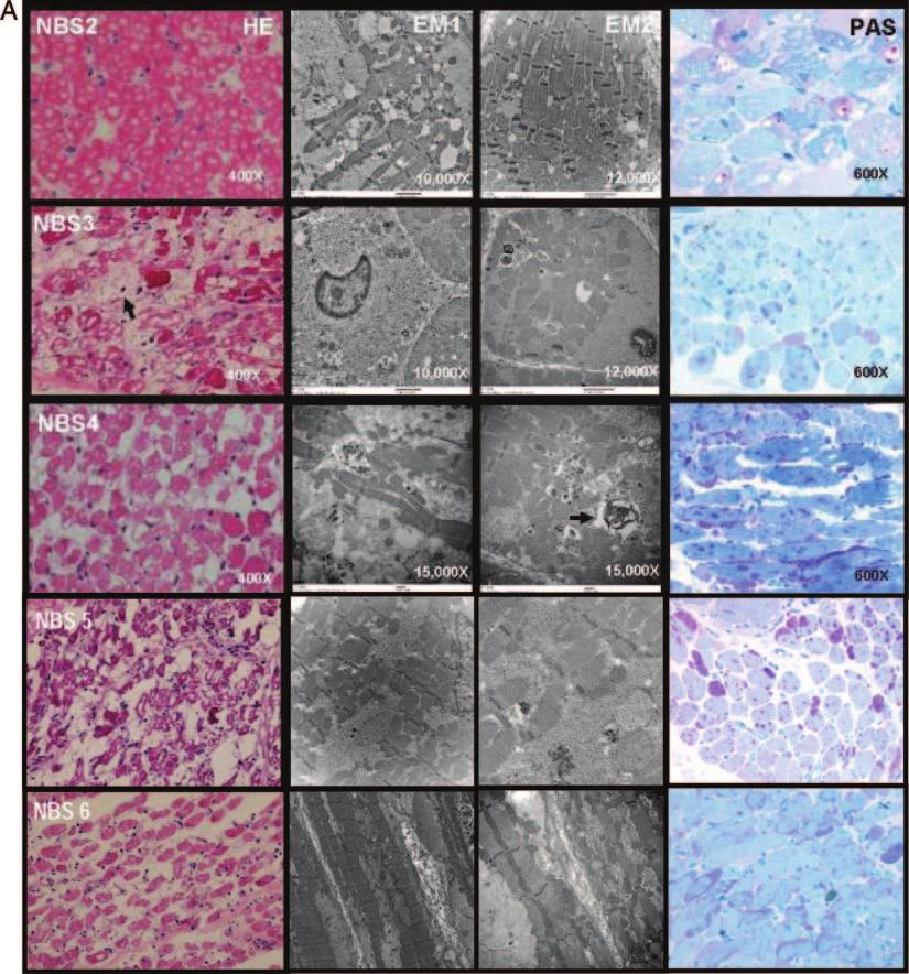 ARTICLES FIGURE 3 Muscle histology (H&E stain, electron microscopy, and PAS stain) at the time of diagnosis (A) and 6 months after treatment (B) for NBS2 to NBS6.