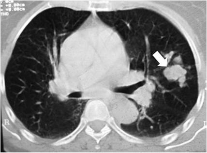 Case 2: Final Diagnosis AFB cultures negative 5-pound weight loss Follow-up CXR unchanged CT guided needle biopsy: adenocarcinoma of the lung Case 3: Clinical Presentation