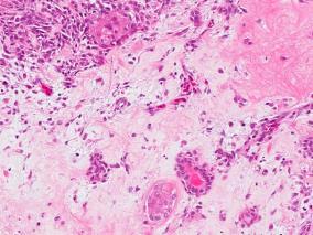 Benign Neoplasm Pleomorphic adenoma and Warthin tumor most common (>80% of salivary gland tumors) Includes less commonly encountered benign mesenchymal neoplasms (schwannoma) Prior literature: