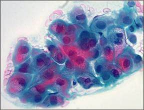 Mucoepidermoid CA Warthin tumor Oncocytic Neoplasms IHC IHC