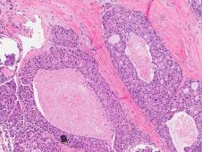 Carcinomas Specific  possible without immunohistochemical stains