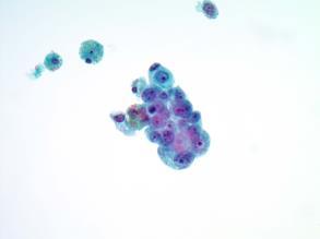 Salivary Duct Carcinoma Immunohistochemical stains
