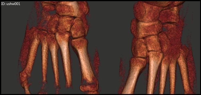Clinical Relevance of the PedCat Study: The study demonstrates the malalignment of the tarsometatarsal joints and the severe post-traumatic degenerative changes through the midfoot.