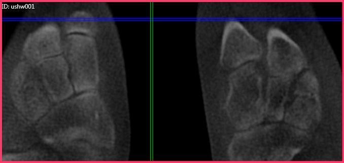 Case H (Figure 2): PedCat CBCT transverse plane reconstruction of right Lisfranc midfoot dislocation compared to normal left foot.
