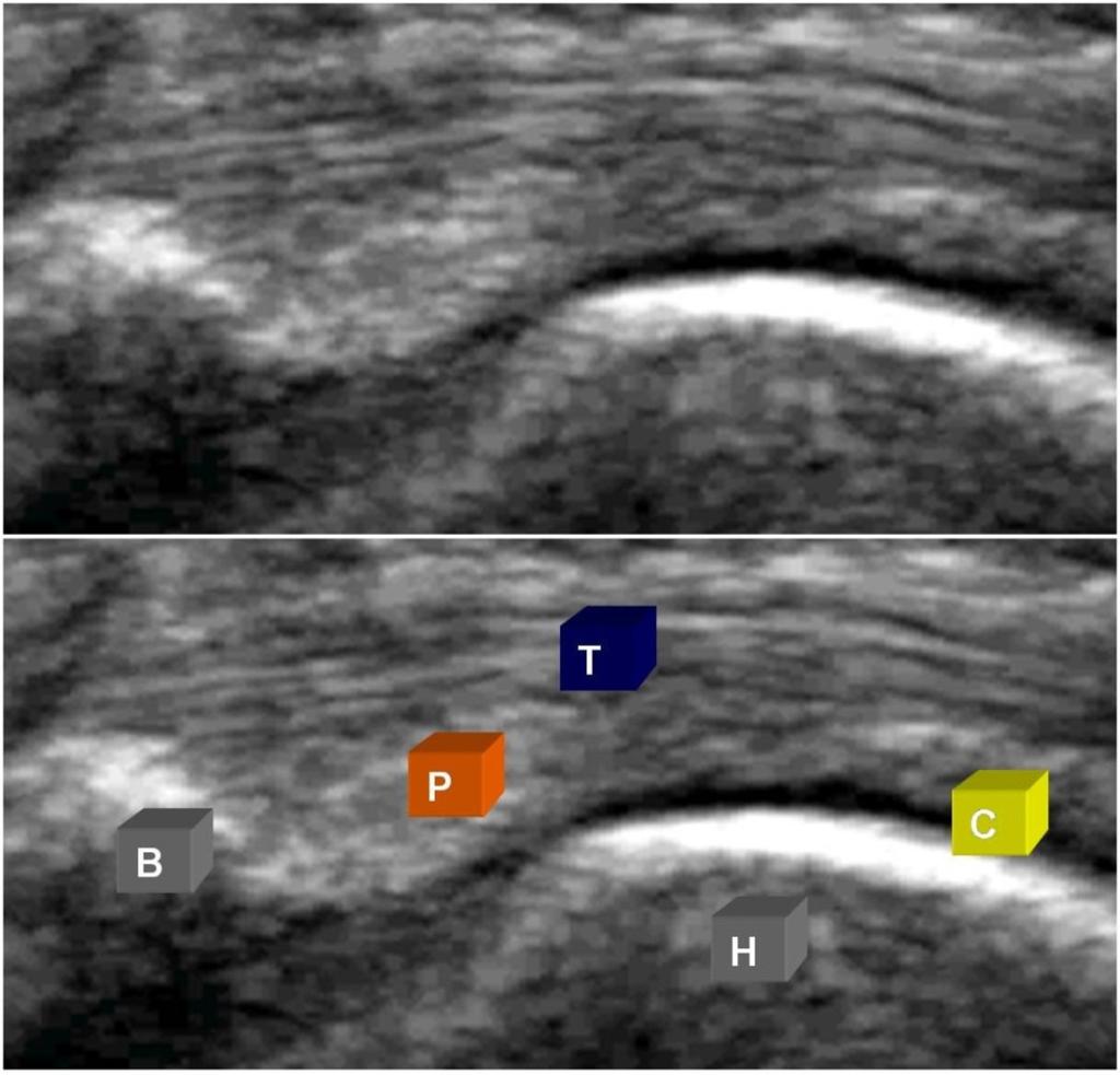 Fig. 3: Normal ultrasound anatomy of MTPJ.