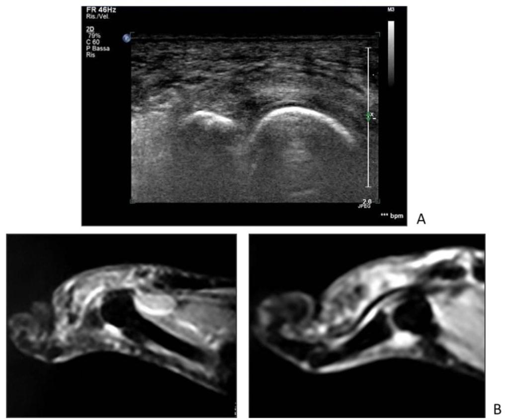 Fig. 6: Partial plantar plate rupture at the distal inserction on