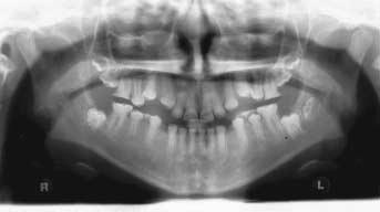 There is also a risk that the second premolar may become impacted against the second permanent molar if it has a distal angulation radiographically or if the second premolar escapes from the guiding