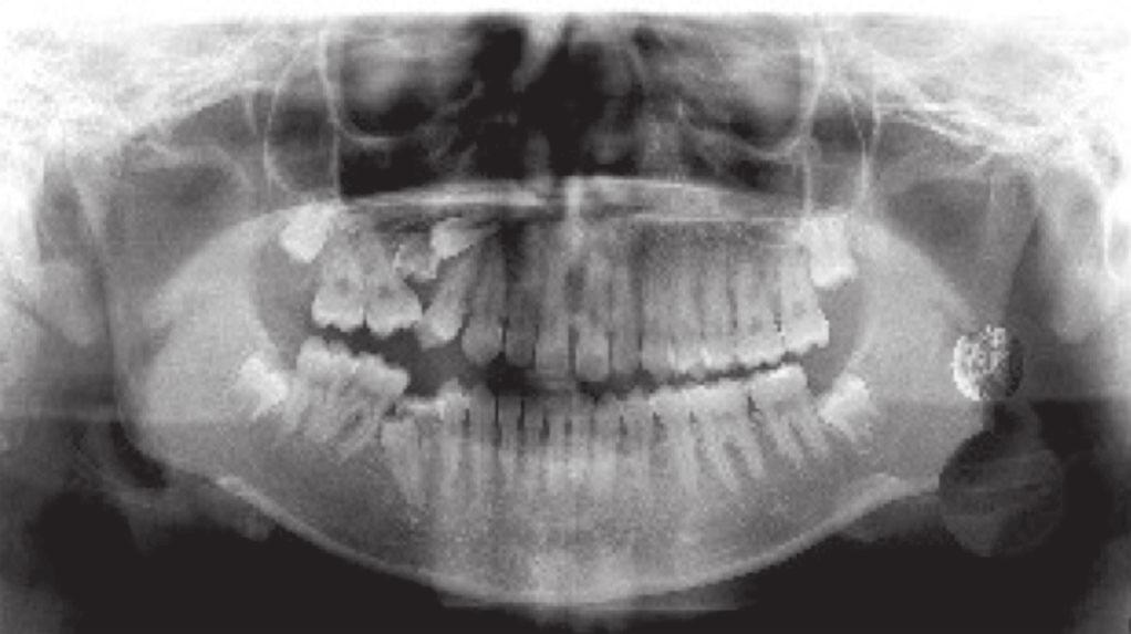 Five months after the extraction of the supernumerary tooth a descent of the second premolar was observed. (fig.