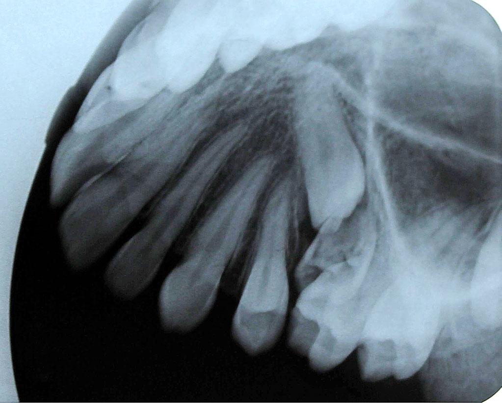 2: a) An OPG showing a supernumerary second premolar b) An orthopantomography after extraction of the deciduous fifth tooth showing a significant improvement in the position of the permanent premolar