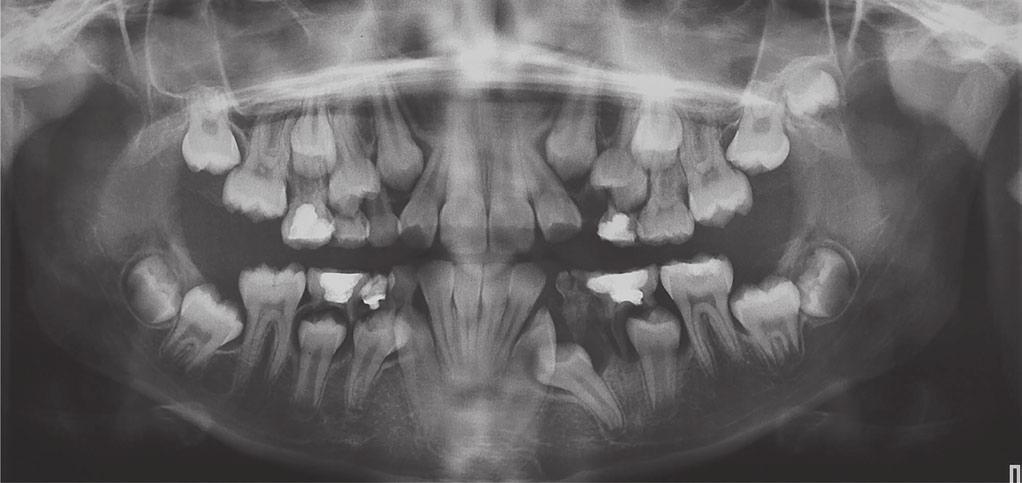 An orthopantomography revealed the presence of a follicular cyst on the lower first premolar on the left and a mesial inclination of the premolar towards the canine. (Fig.