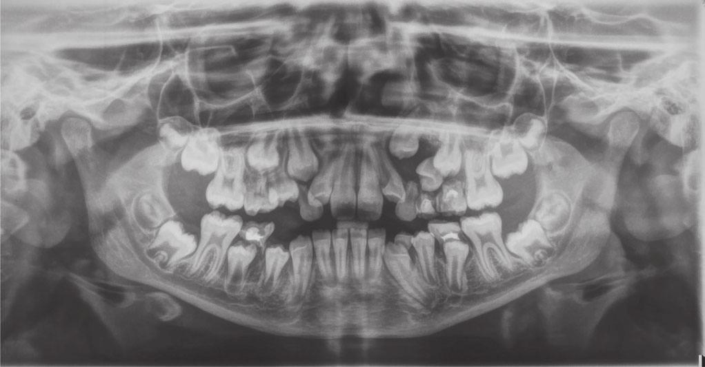 A year and a half later the patient returned for a follow-up check; however, the prescribed teeth extraction had not been performed.